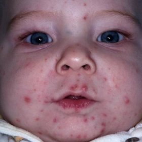 Očkování proti neštovicím – záhada hlavolamu - Vitalia.cz