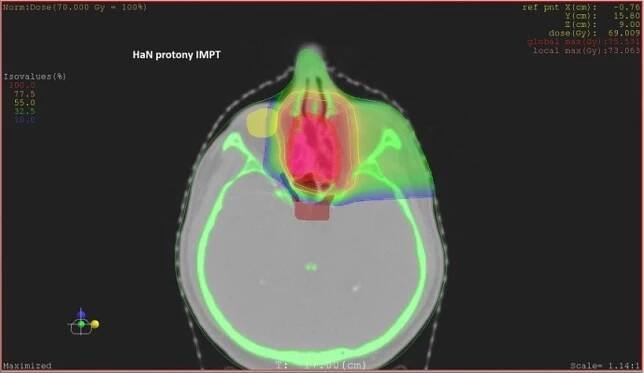 Protonová radioterapie nádorů ORL v PTC | PTC.CLINIC – Informace pro odborníky