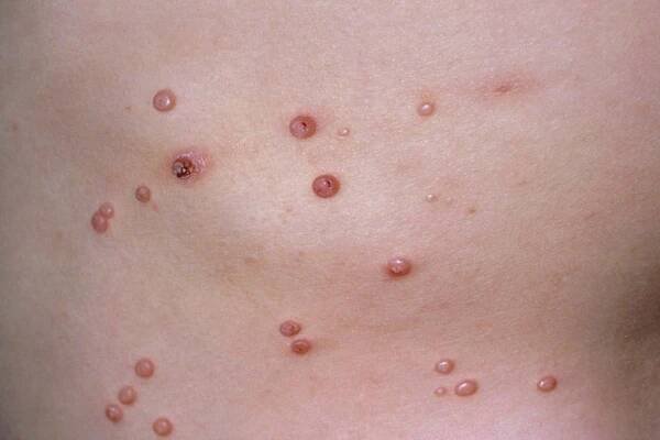 Introduction to Molluscum Contagiosum: What is it? - MyNewsBuZZ