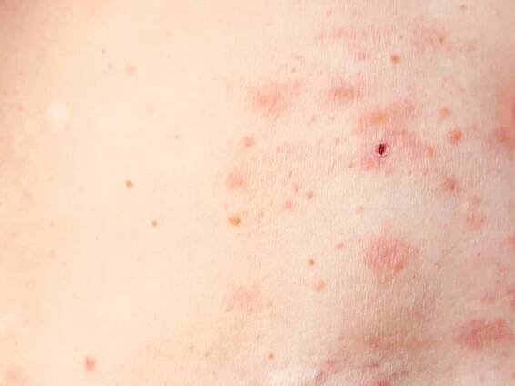 Kožní vyrážka léčba na těle ženy. pásový opar, choroba, herpes zoster, virus varicella-zoster. kožní vyrážka a puchýře na těle — Stock obrázek