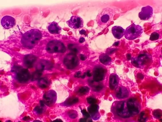 fotomikrograf metastazujícího adenokarcinomu plic. pleurální tekutina fnac. 200× více - metastáza - stock snímky, obrázky a fotky