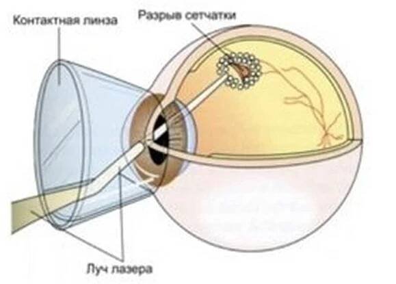 Laserová koagulace sítnice / Retina