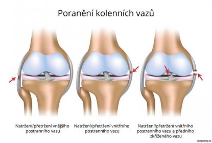 Vymknutí‚ podvrtnutí kolena - příznaky a léčba