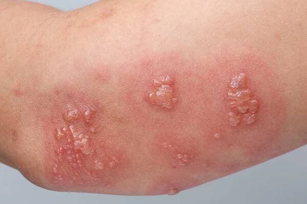 Can Shingles Kill You?