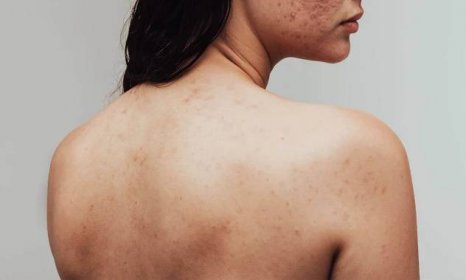 Body Acne Guide: Causes & How to Get Rid of It