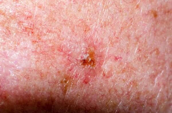 Nevus nebo papilom nebo krtek nebo melanom nebo keratóza na kůži dospělého — Stock obrázek