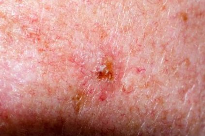 Nevus nebo papilom nebo krtek nebo melanom nebo keratóza na kůži dospělého — Stock obrázek