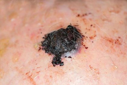 Rakovina kůže: Které části těla jsou nejohroženější? Co je melanom kůže? –  Info Pacient