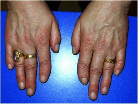 Hands showing brachymesophalangy