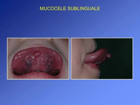 MUCOCELE SUBLINGUALE 3