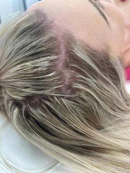 Before & After | PRP HAIR RESTORATION | | GLANZ Aesthetics | Doral, FL