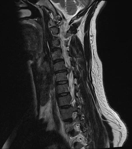  Výhřez meziobratlové ploténky krční páteře_MRI boční pohled