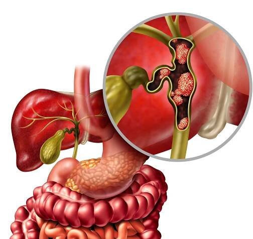 Karcinom žlučovodu nebo cholangiokarcinom se žlučníkem a játry jako onemocnění trávicího ústrojí představující koncept lékařské péče v anatomii lidských orgánů s 3D ilustračními prvky. — Stock obrázek