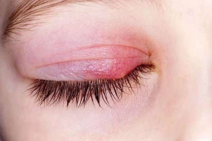 Gerstenkorn: Ursachen + 4 Hausmittel gegen die Entzündung im Auge