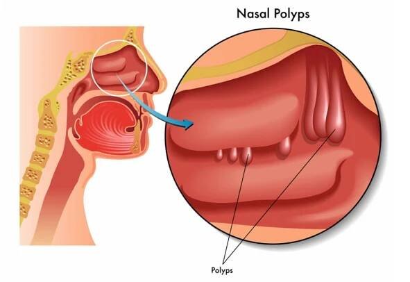Chronická rinosinusitida s nosními polypy (CRSwNP) – Global Allergy & Airways Patient Platform