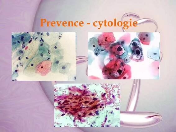 Prevence - cytologie
 