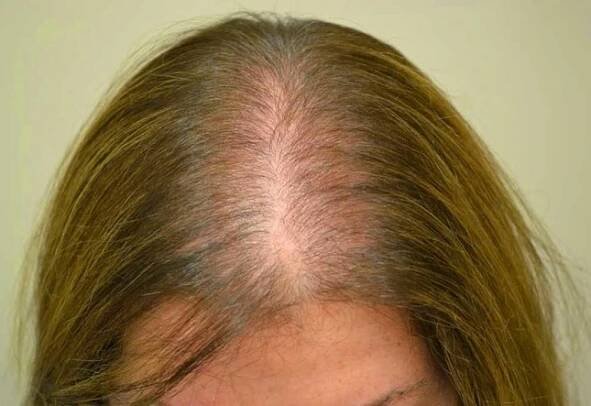 Androgenetická alopecia způsobuje a léčí onemocnění / Články