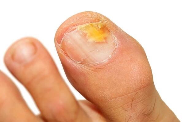 onychomykóza plísňová infekce nehtu. - nail fungus - stock snímky, obrázky a fotky