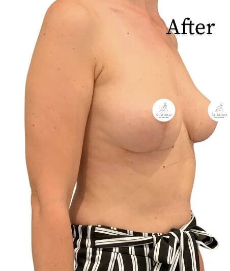 PL-Modelace prsou | Prague aesthetic Clinic