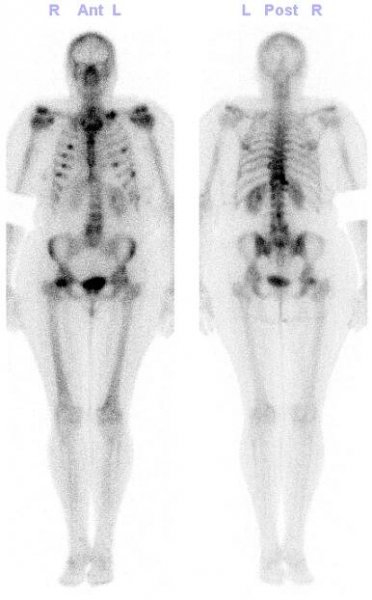 Obr. č. 2: Celotělová scintigrafie skeletu v kostní fázi vyšetření – mnohočetná ložiska zvýšené kostní přestavby ve výše uvedených lokalizacích.