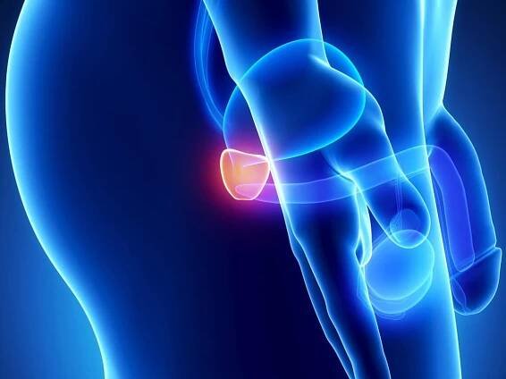 Chronic prostatitis