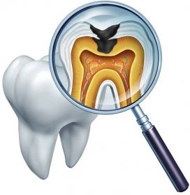 Zubní dutiny zblízka