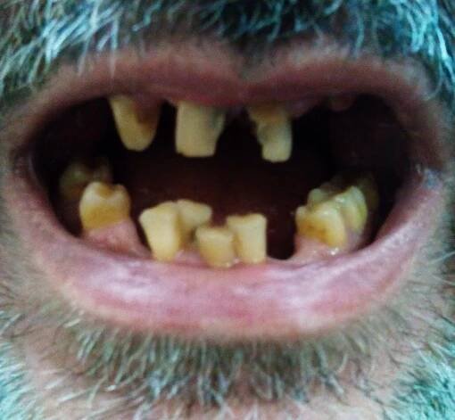 Tooth discoloration