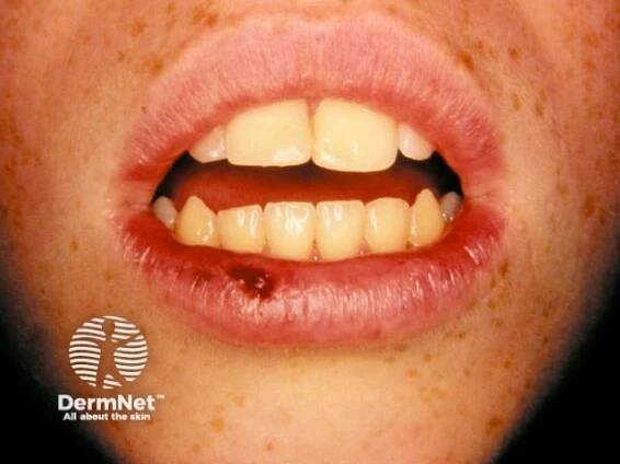 Herpes Simplex Images