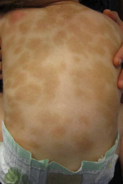 Urticaria pigmentosa