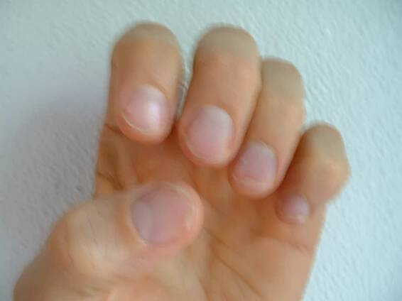 HOW TO BEAT PSORIASIS