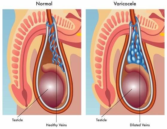 Human varicocele anatomy — Ilustrace