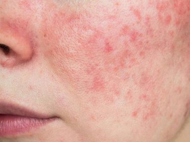 Everything You Need To Know About Rosacea - Chatelaine