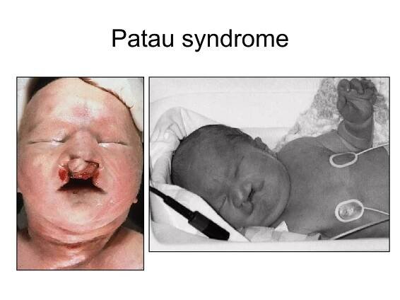 Patau syndrome 