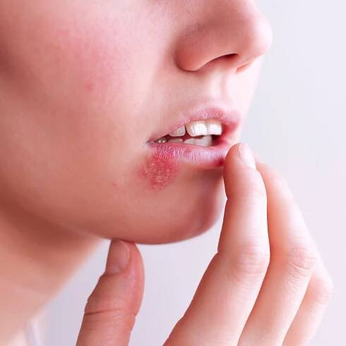 Differences Between HSV-1 and HSV-2: Oral and Genital Herpes