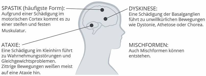 Infantile Cerebralparese