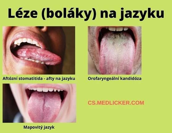 Léze na jazyku - mapovitý jazyk, afty, orofaryngeální kandidóza