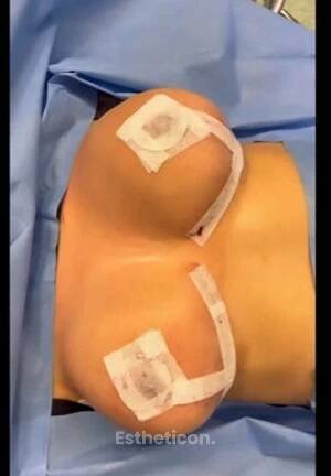 Modelance prsou - MEDICOM Clinic
