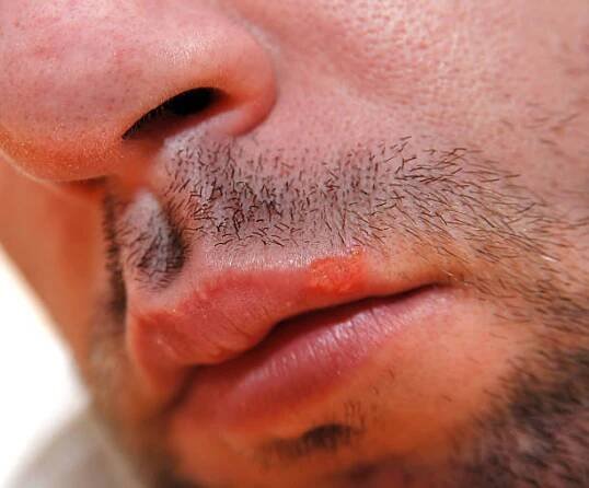 herpes labialis, opar nebo puchýř s horečkou - opary oparech - stock snímky, obrázky a fotky