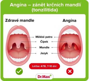 Angína – pohled na zdravé mandle a mandle zasažené angínou
