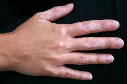Viticell - nový přístup k léčení vitiligo / Články