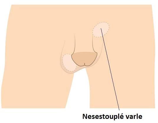 Nesestouplé varle (kryptorchismus) – proč a jak vzniká? Příznaky, příčiny, léčba