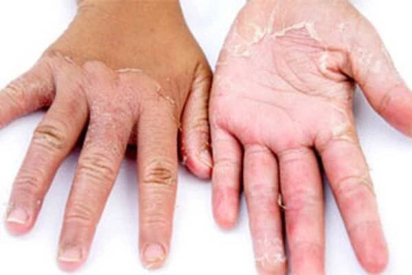 Kožní formy Ichthyosis, příznaky a léčba / Ichthyosis | Užitečné informace a tipy na péči o sebe. Zdraví, výživa a další
