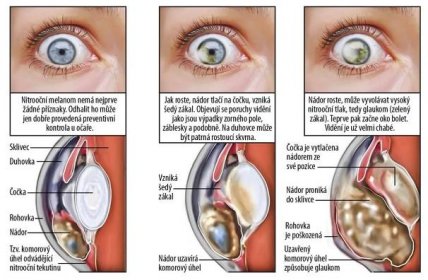 Jak vypadá oční melanom?