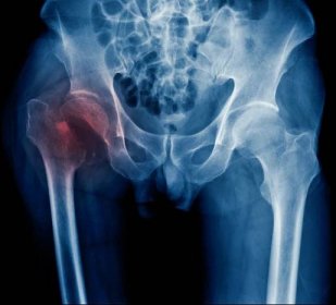 rentgenová zlomenina kyčle starého muže, rentgenový obraz intertrochanterické zlomeniny - zlomenina - stock snímky, obrázky a fotky