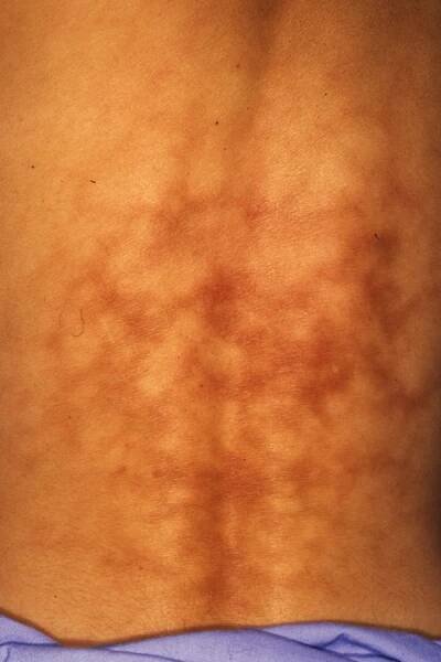 Erythema ab igne or toasted skin syndrome on the back
