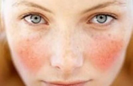 Symptomy růžovky nejsou jen červené tváře. My naštěstí víme, jak se jich zbavit