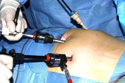 Hořovičtí začali operovat kýlu laparoskopicky