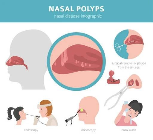 nosní onemocnění. nosní polypy příčiny, diagnostika a léčba lékařské infografické design - nasal epithelium stock ilustrace