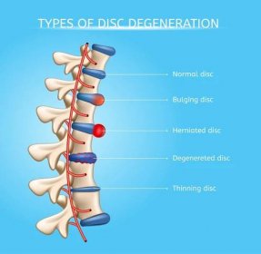 Intervertebral Disc Degeneration Types Vector