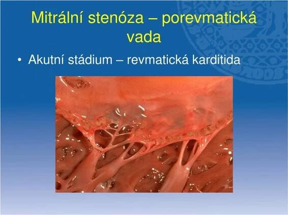 PPT - Chlopenní vady I PowerPoint Presentation, free download - ID:4651565